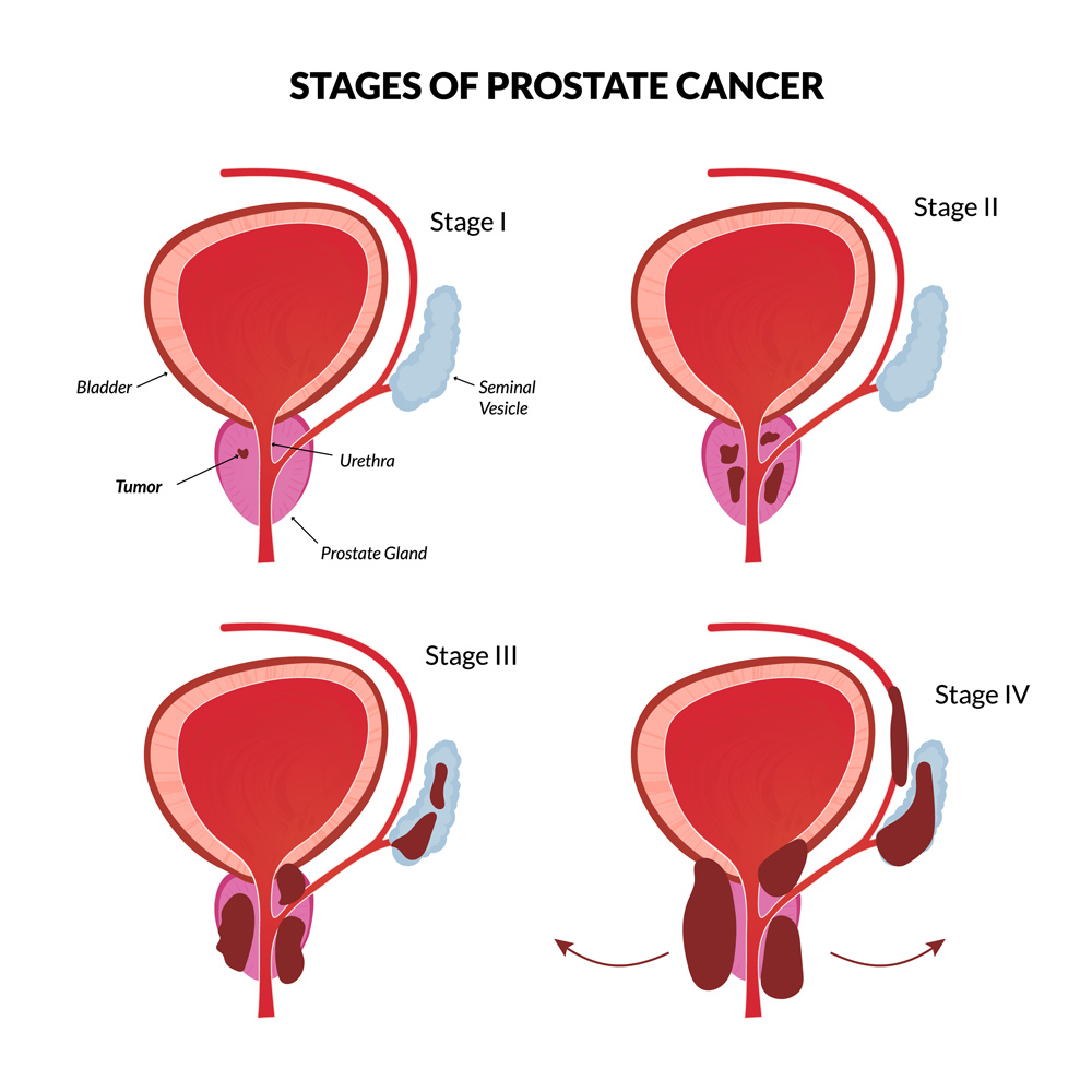 Prostate Treatment